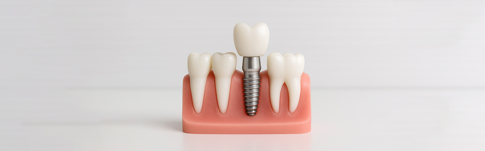 The Benefits of Dental Implants: Why They’re a Permanent Solution