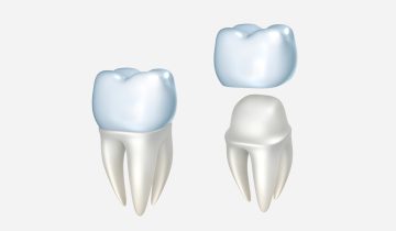 Signs You May Need a Crown: Don’t Ignore These Dental Issues