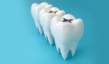 Common Symptoms That Mean You Need a Dental Filling